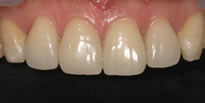 上顎4前歯の審美セラミックス治療