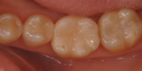 奥歯（臼歯部）のセラミックス治療