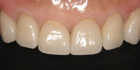 上顎6前歯の審美セラミックス治療