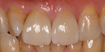 上顎2前歯のセラミックス治療