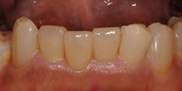 下顎前歯部の審美セラミックス治療