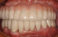 歯周病治療とインプラント治療