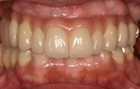 重度歯周病治療とインプラント治療