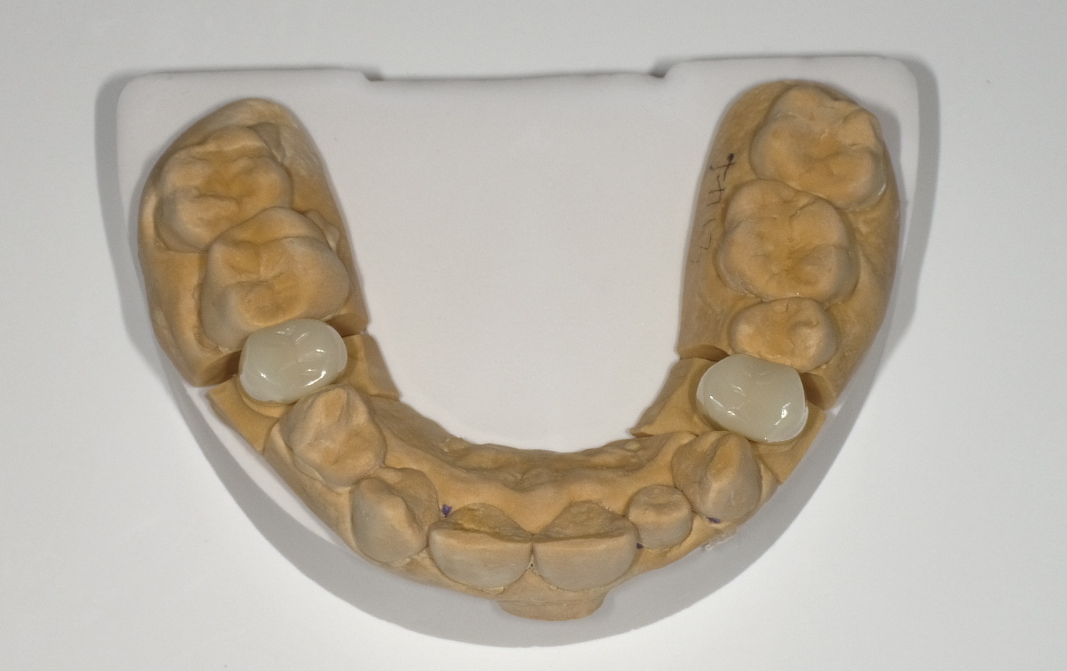保険適応の白いかぶせ物(CAD.CAM冠）症例 | 和泉府中駅近くの木下歯科クリニック