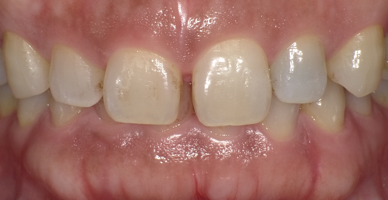 歯 と 歯 の 隙間 埋める